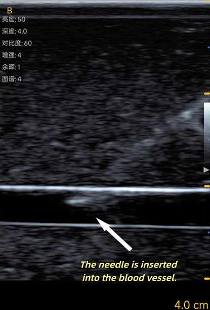 Ultrasound Vascular Puncture T - Medical Gel Ultrasound 评论和价格